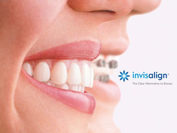 Invisalign